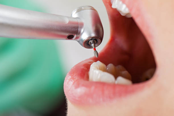 Best Knocked-Out Tooth (Avulsed Tooth) Treatment in Malvern, PA